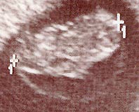 Ultrasound closeup